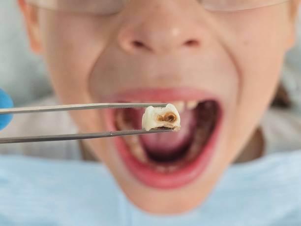 Best Emergency Tooth Extraction in Coats, NC